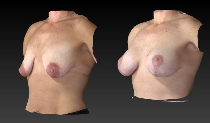 Before & After Breast Procedures Case 185 View #3 View in Toledo, Ohio