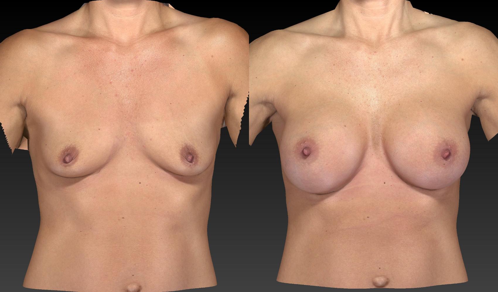Before & After Breast Procedures Case 191 View #1 View in Toledo, Ohio