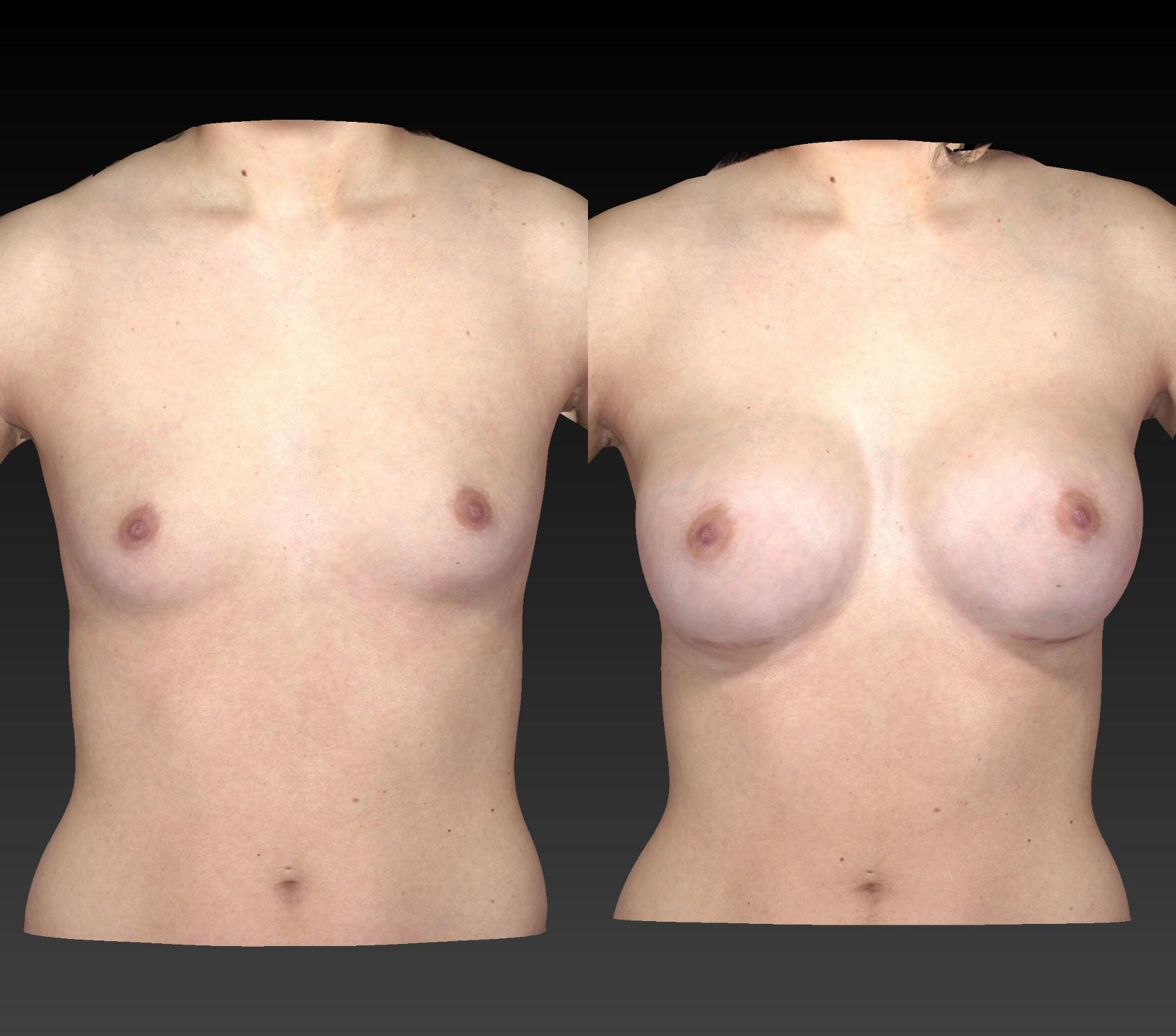 Before & After Breast Procedures Case 193 View #1 View in Toledo, Ohio