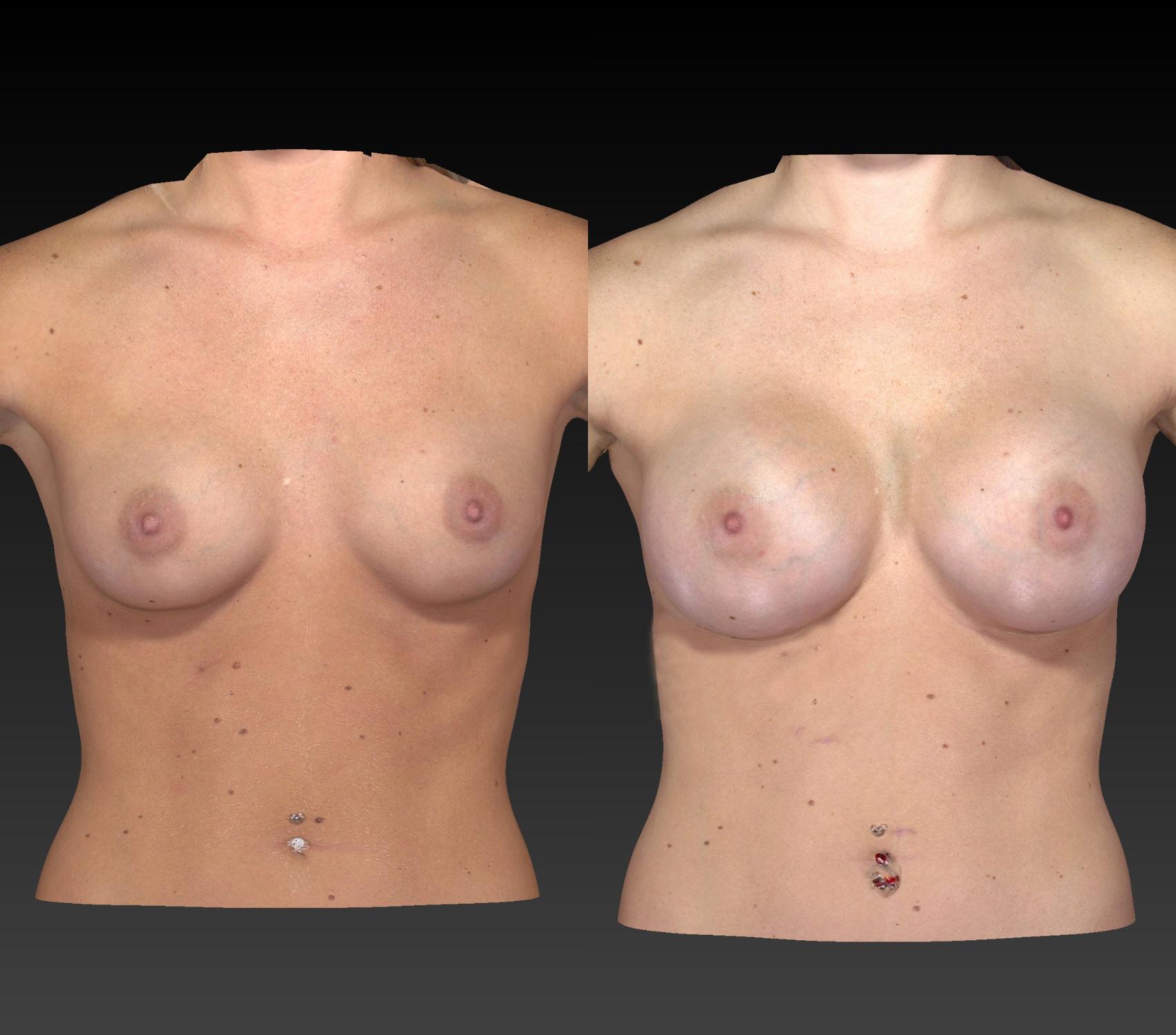 Before & After Breast Procedures Case 195 View #1 View in Toledo, Ohio