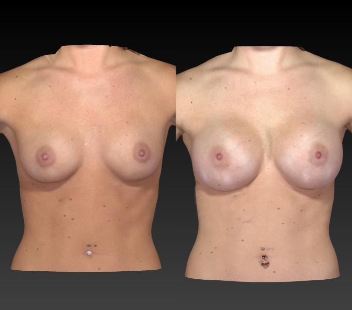 Before & After Breast Procedures Case 195 View #1 View in Toledo, Ohio