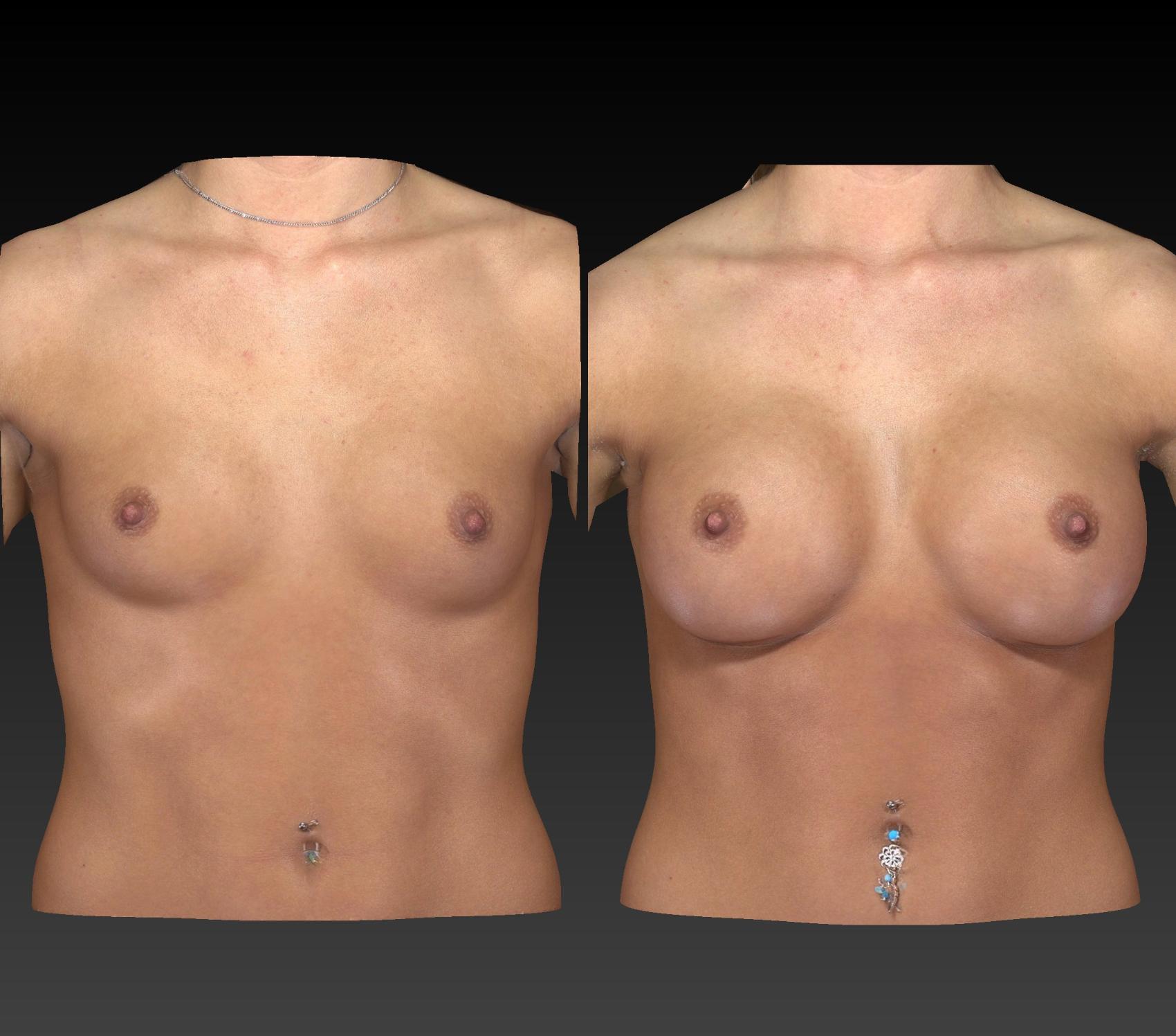 Before & After Breast Procedures Case 199 View #1 View in Toledo, Ohio