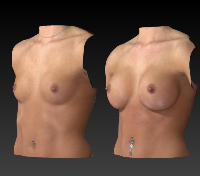 Before & After Breast Procedures Case 199 View #3 View in Toledo, Ohio