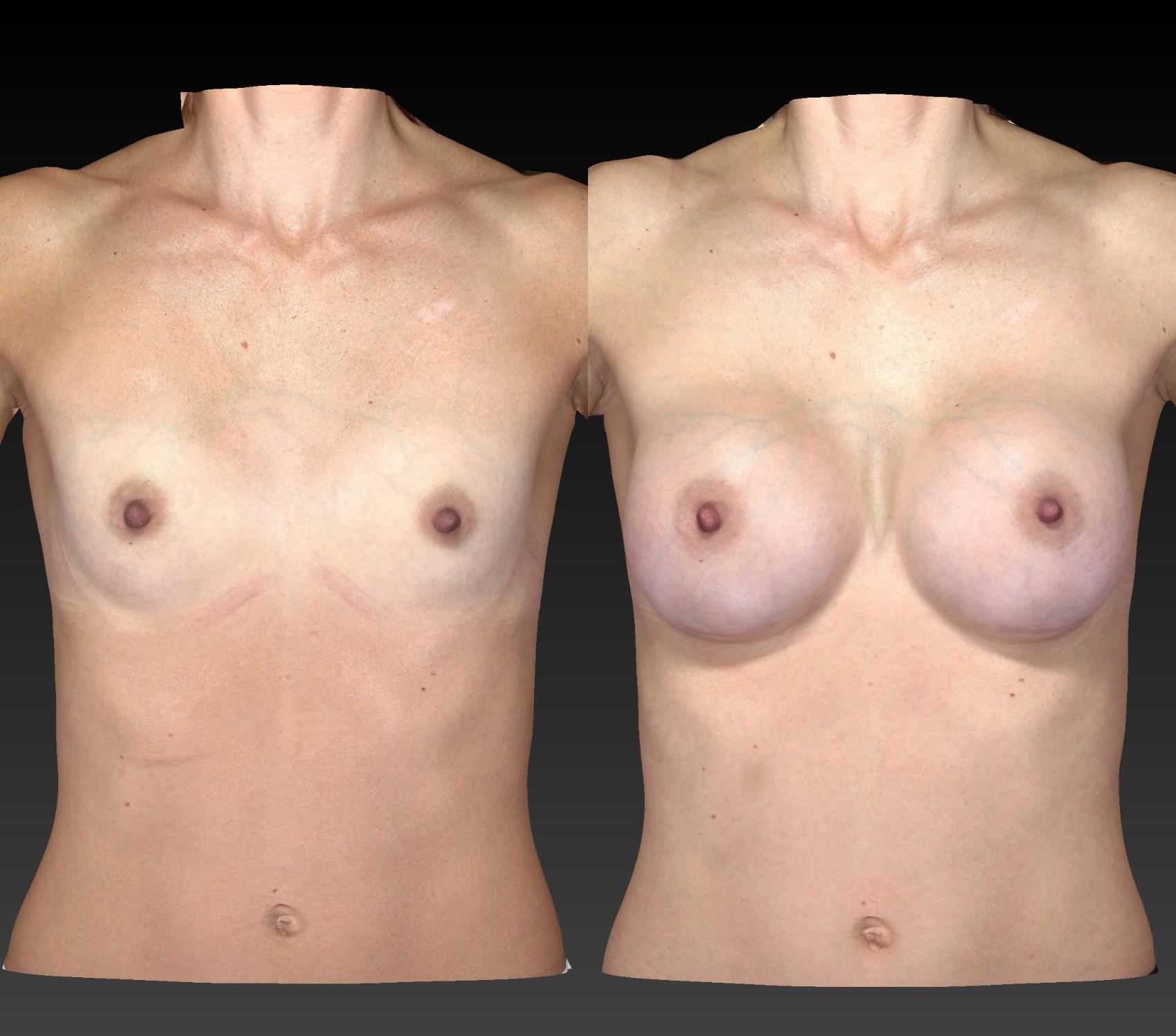 Before & After Breast Procedures Case 260 View #1 View in Toledo, Ohio
