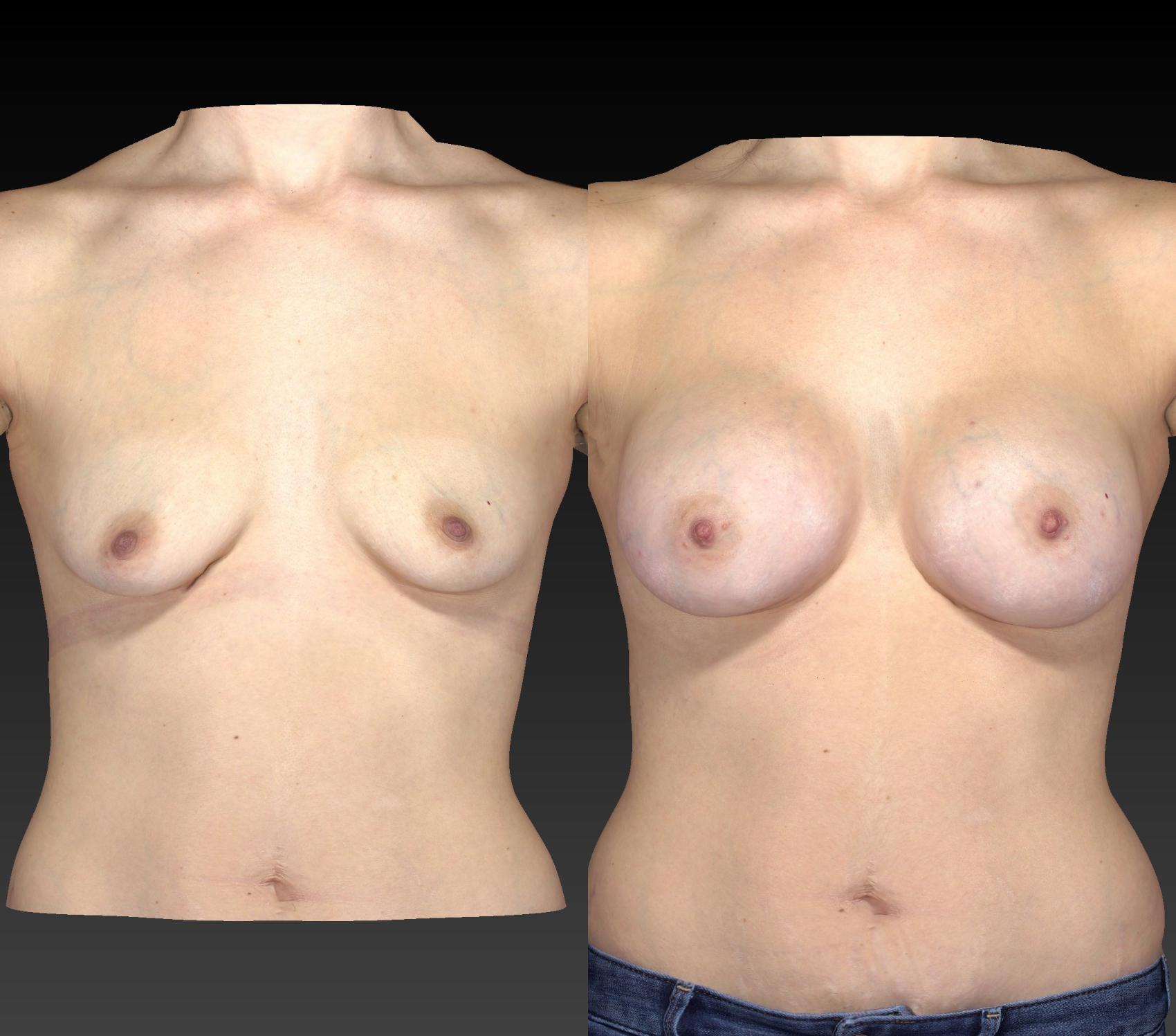 Before & After Breast Procedures Case 262 View #1 View in Toledo, Ohio