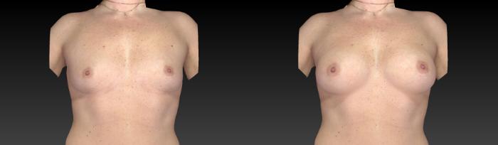 Before & After Breast Procedures Case 365 View #1 View in Toledo, Ohio