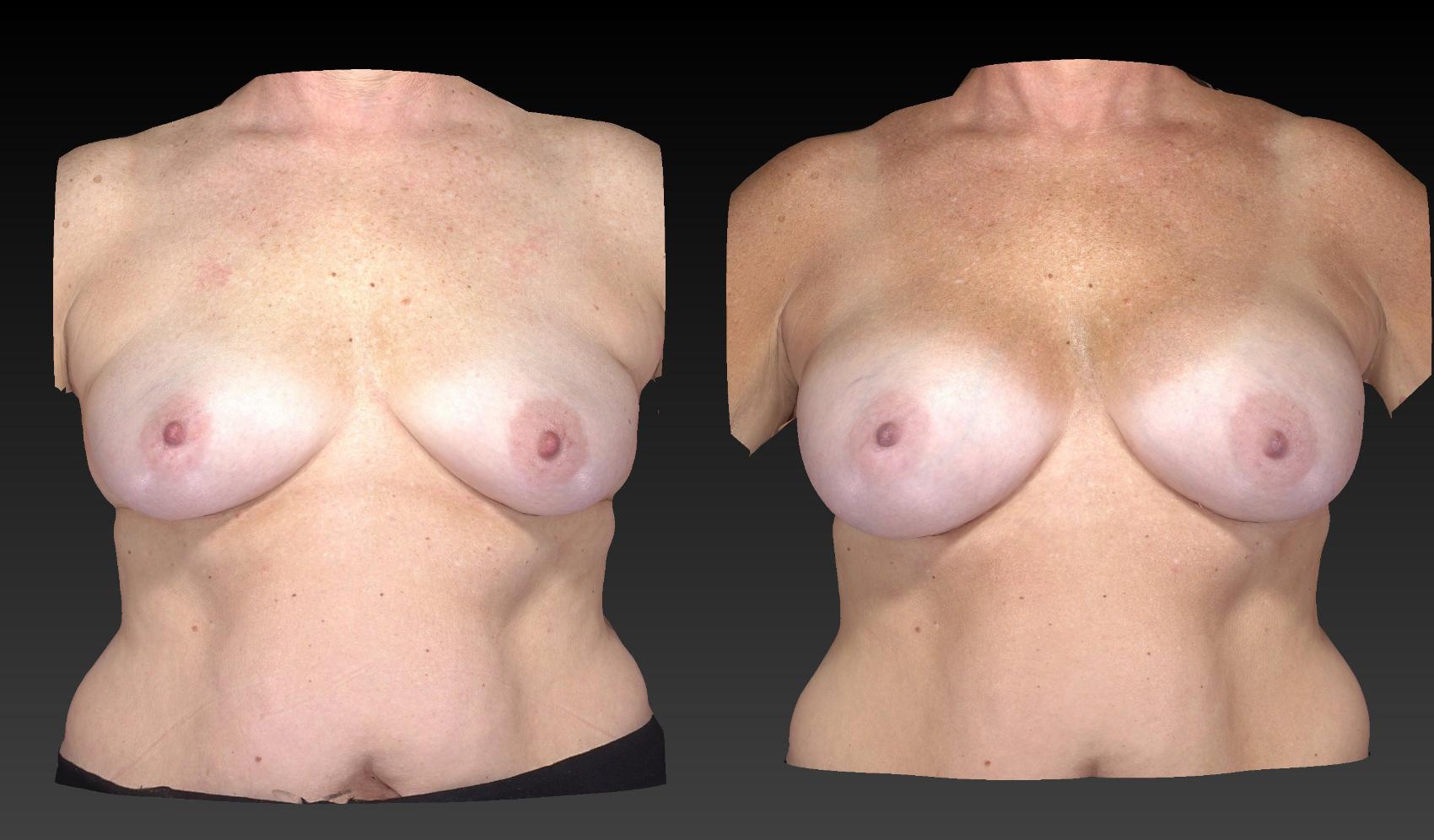 Before & After Breast Procedures Case 366 View #1 View in Toledo, Ohio