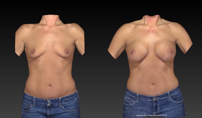 Before & After Breast Procedures Case 369 View #1 View in Toledo, Ohio