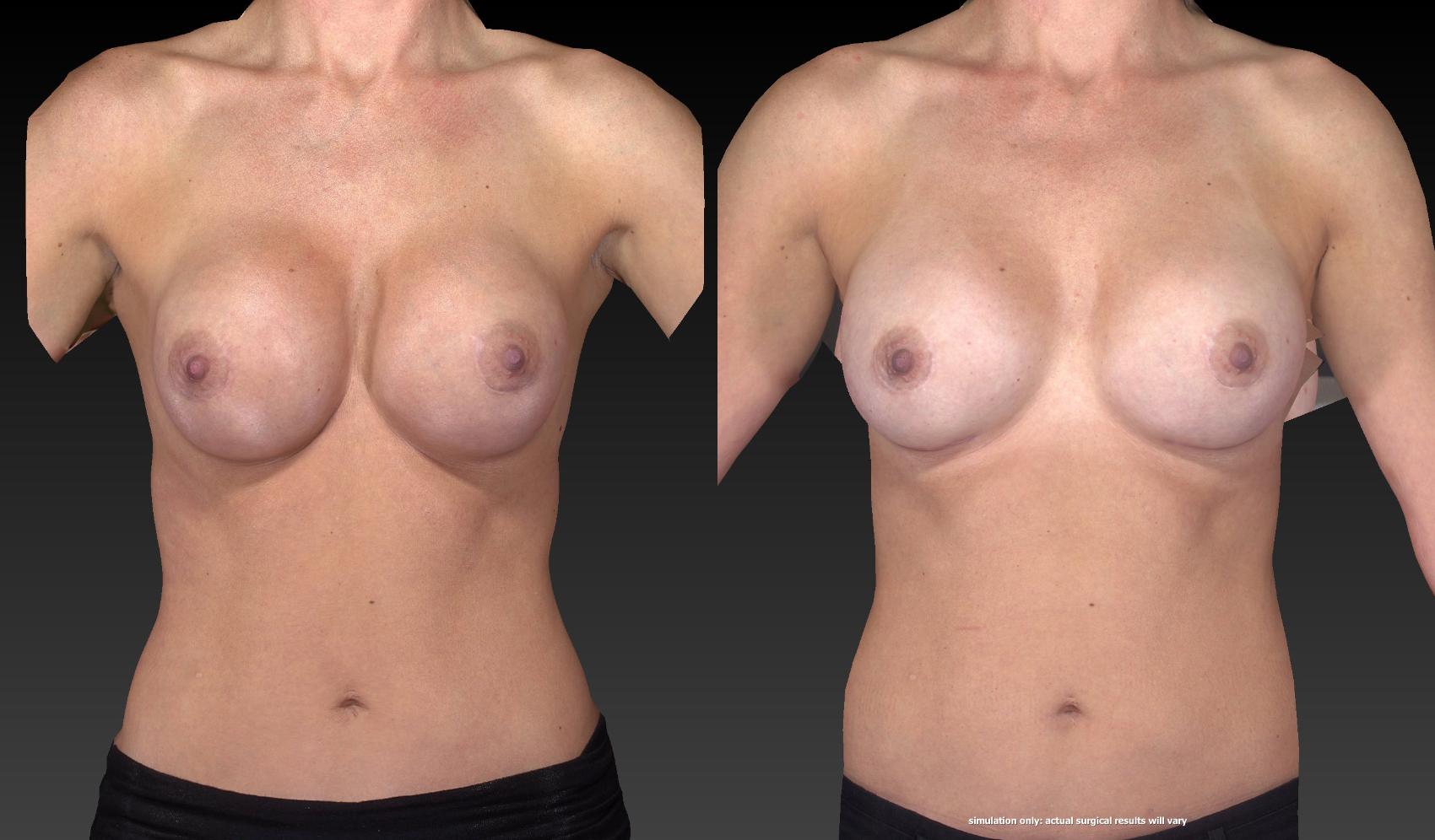 Before & After Breast Procedures Case 372 View #1 View in Toledo, Ohio