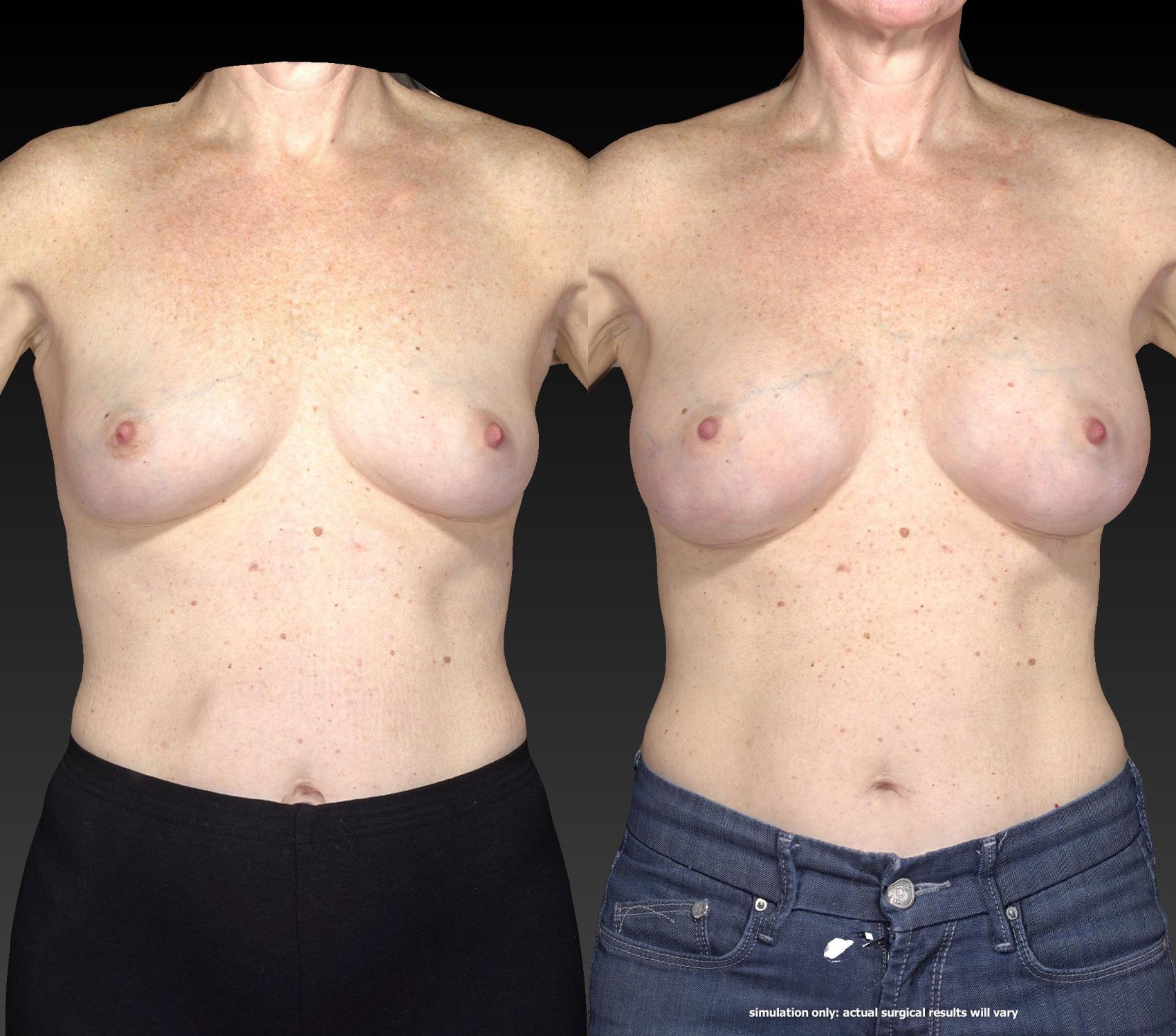 Before & After Breast Procedures Case 374 View #1 View in Toledo, Ohio