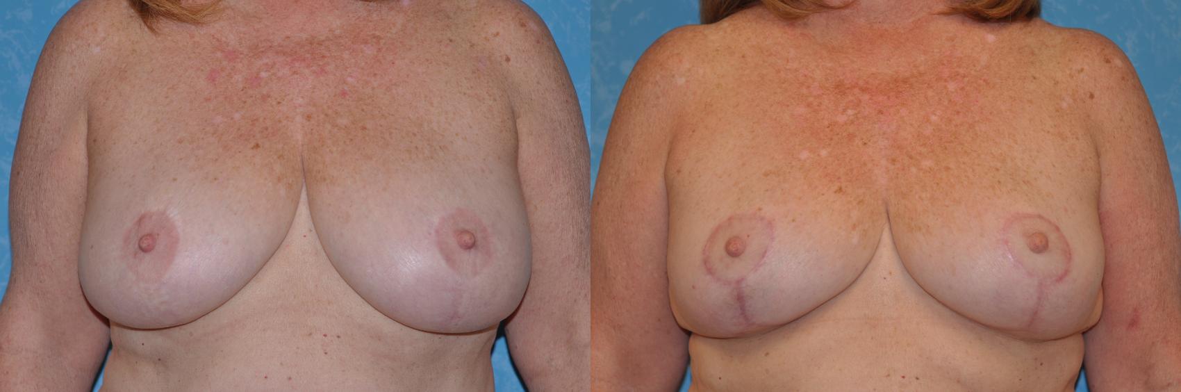 Before & After Breast Reduction Case 140 View #1 View in Toledo, Ohio