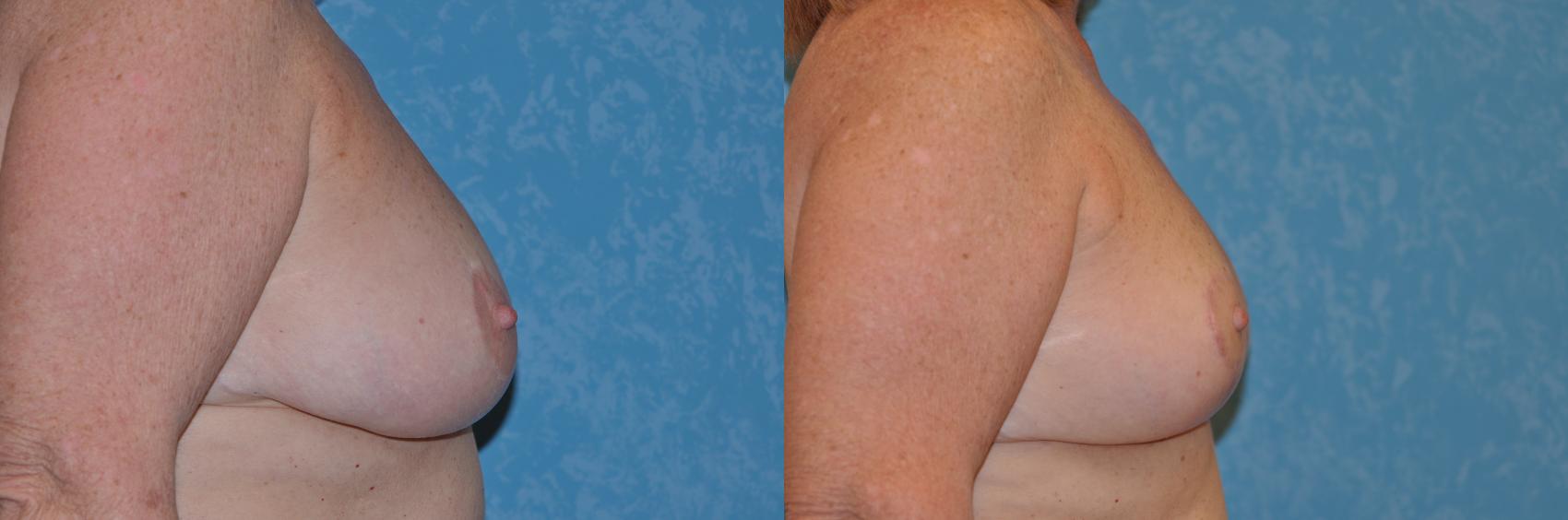 Before & After Breast Reduction Case 140 View #2 View in Toledo, Ohio
