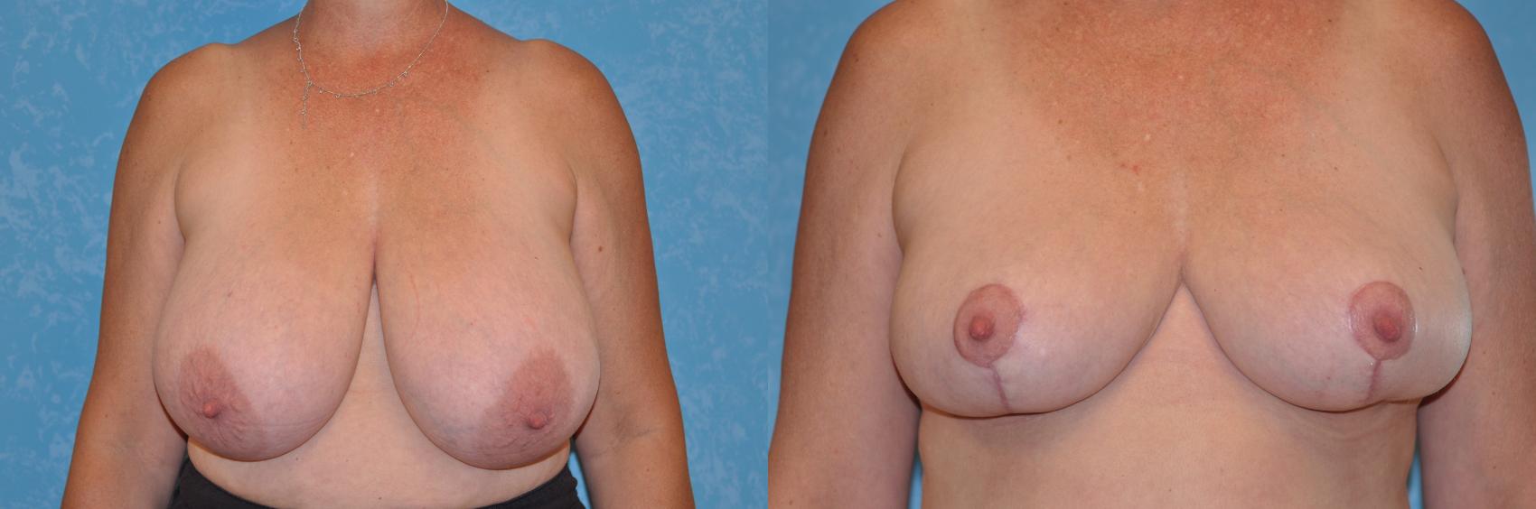 Before & After Breast Reduction Case 156 View #1 View in Toledo, Ohio