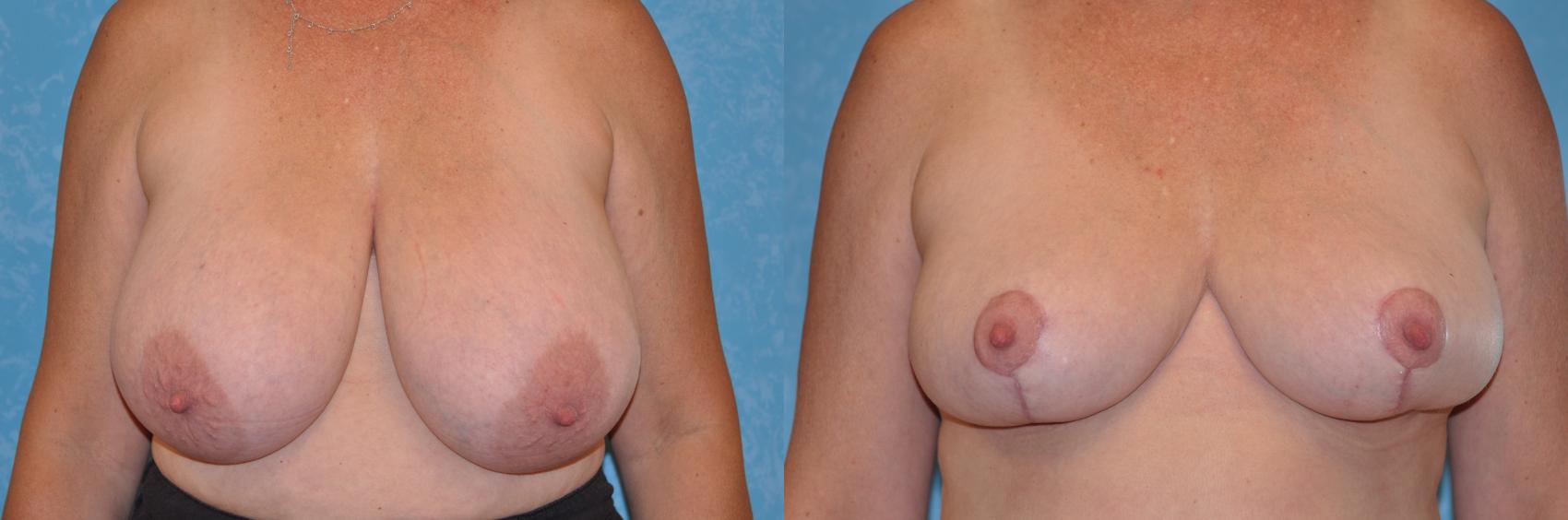 Before & After Breast Reduction Case 156 View #1 View in Toledo, Ohio