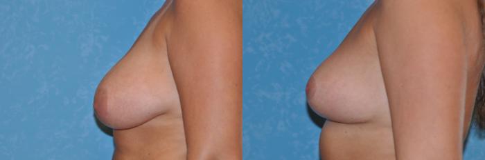 Before & After Breast Reduction Case 190 View #2 View in Toledo, Ohio
