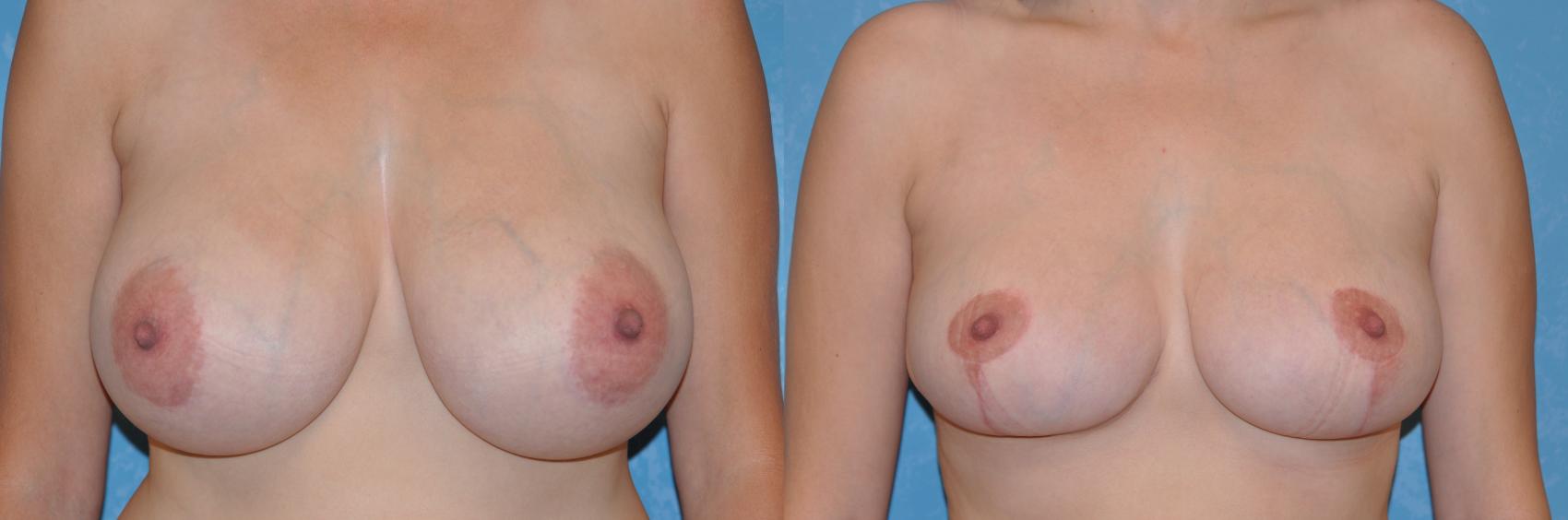 Before & After Breast Reduction Case 233 View #1 View in Toledo, Ohio