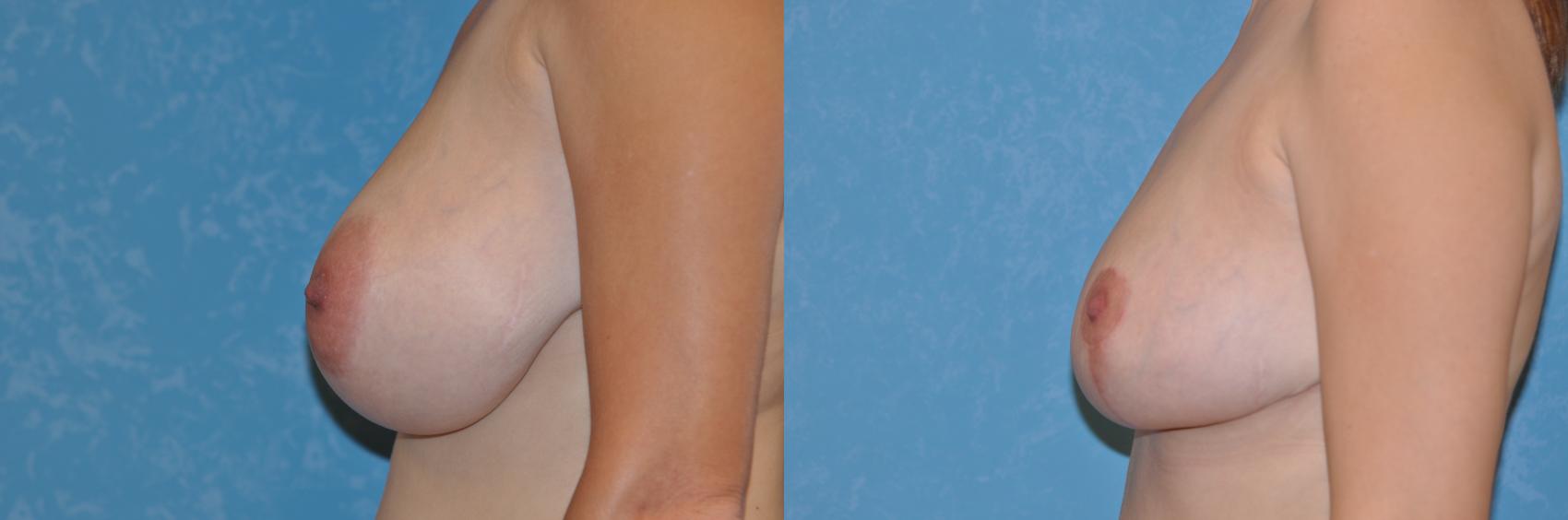 Before & After Breast Reduction Case 233 View #2 View in Toledo, Ohio