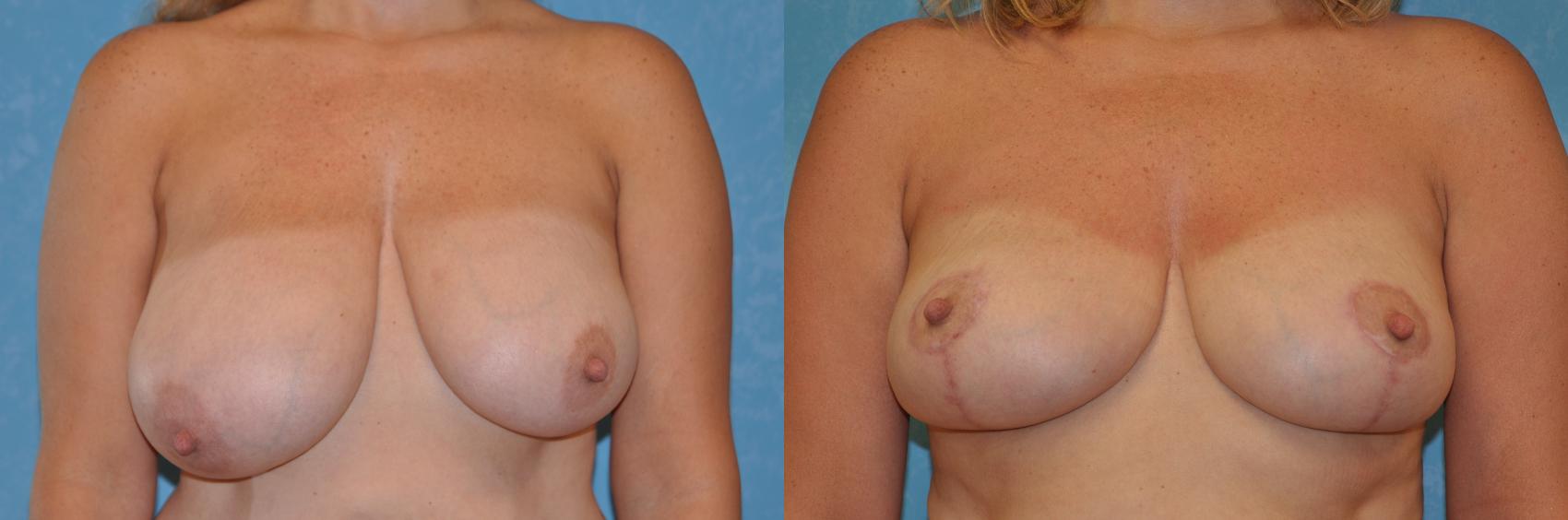 Before & After Breast Reduction Case 250 View #1 View in Toledo, Ohio