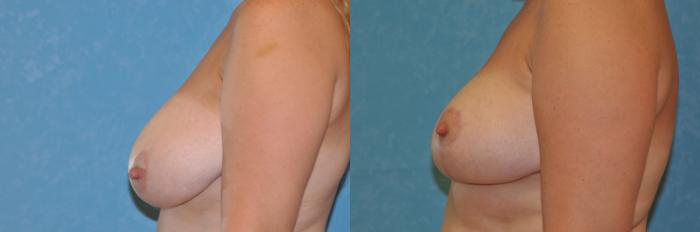 Before & After Breast Reduction Case 250 View #3 View in Toledo, Ohio
