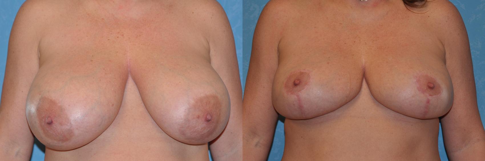 Before & After Breast Reduction Case 264 View #1 View in Toledo, Ohio