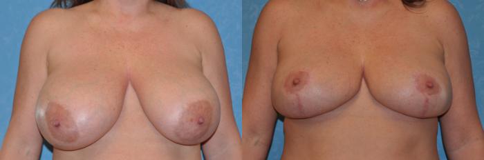 Before & After Breast Reduction Case 264 View #1 View in Toledo, Ohio