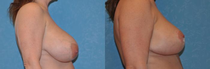 Before & After Breast Reduction Case 264 View #2 View in Toledo, Ohio