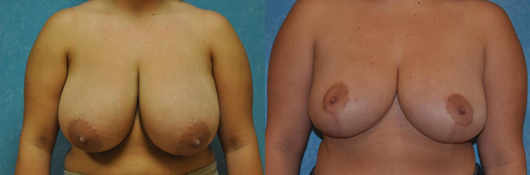 Before & After Breast Reduction Case 278 View #1 View in Toledo, Ohio