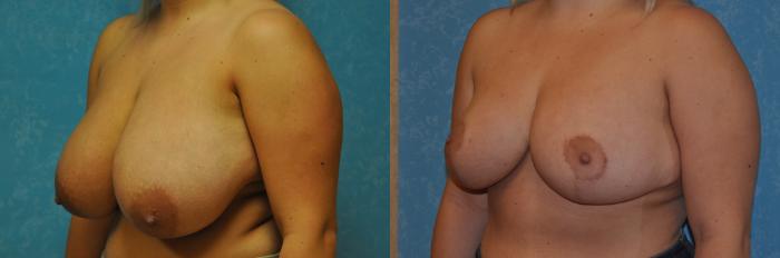 Before & After Breast Reduction Case 278 View #2 View in Toledo, Ohio