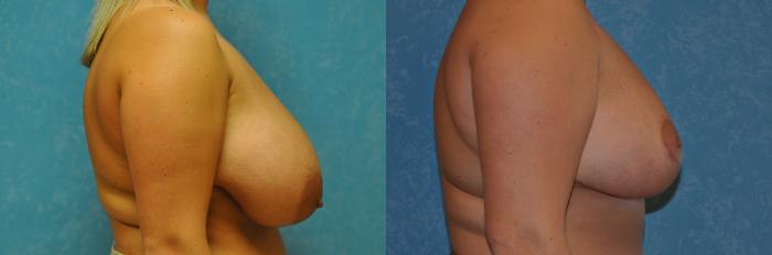 Before & After Breast Reduction Case 278 View #3 View in Toledo, Ohio