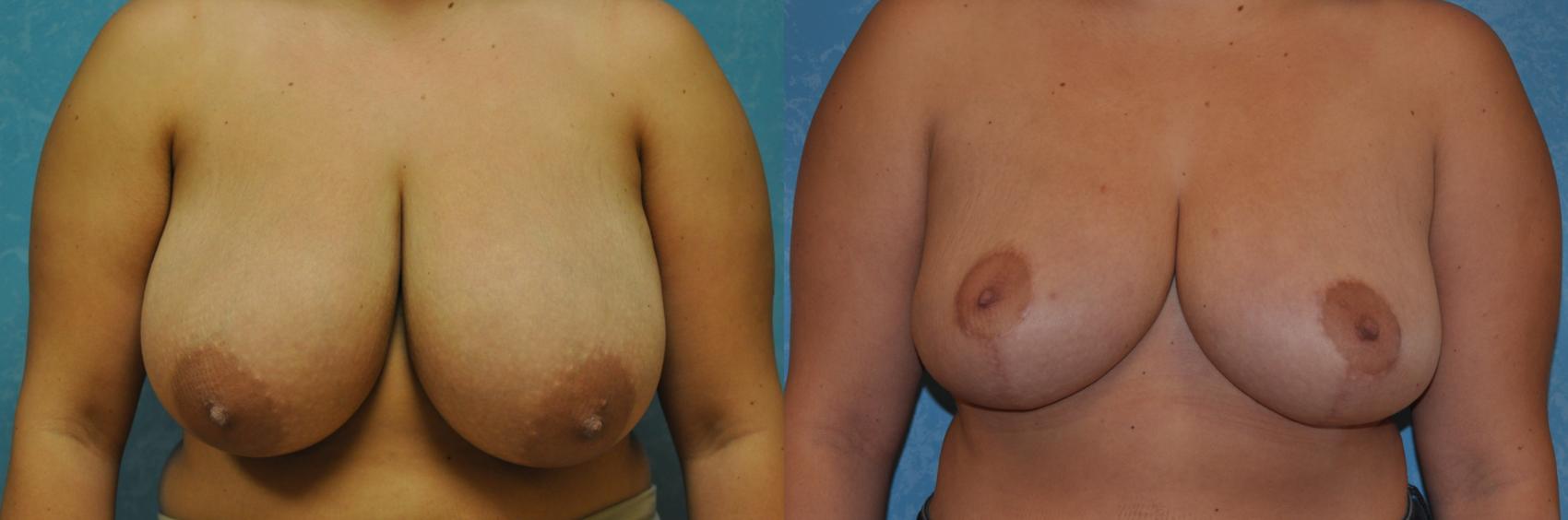 Before & After Breast Reduction Case 280 View #1 View in Toledo, Ohio