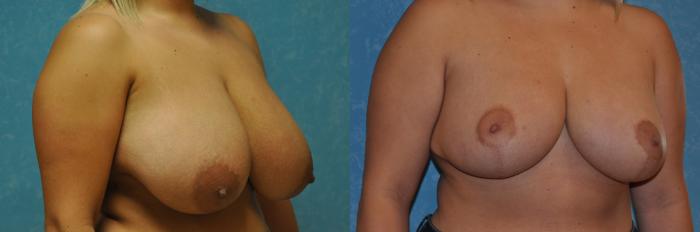 Before & After Breast Reduction Case 280 View #3 View in Toledo, Ohio