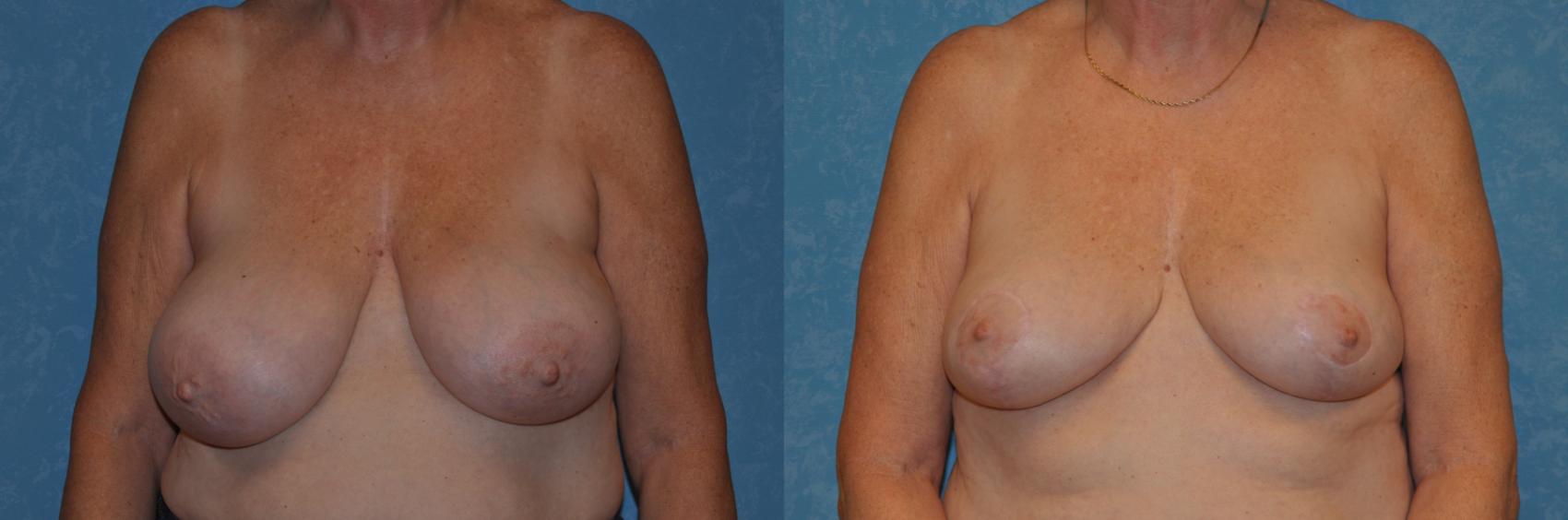 Before & After Breast Reduction Case 340 View #1 View in Toledo, Ohio