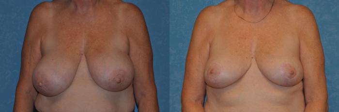Before & After Breast Reduction Case 340 View #1 View in Toledo, Ohio