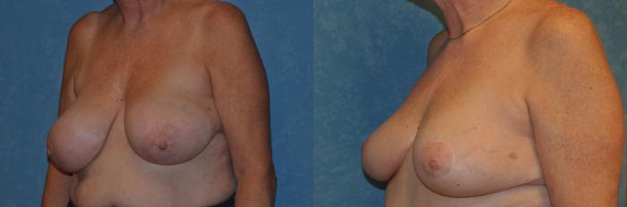 Before & After Breast Reduction Case 340 View #2 View in Toledo, Ohio