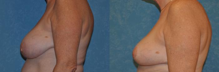 Before & After Breast Reduction Case 340 View #3 View in Toledo, Ohio