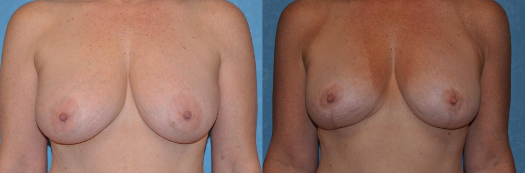 Before & After Breast Reduction Case 343 View #1 View in Toledo, Ohio