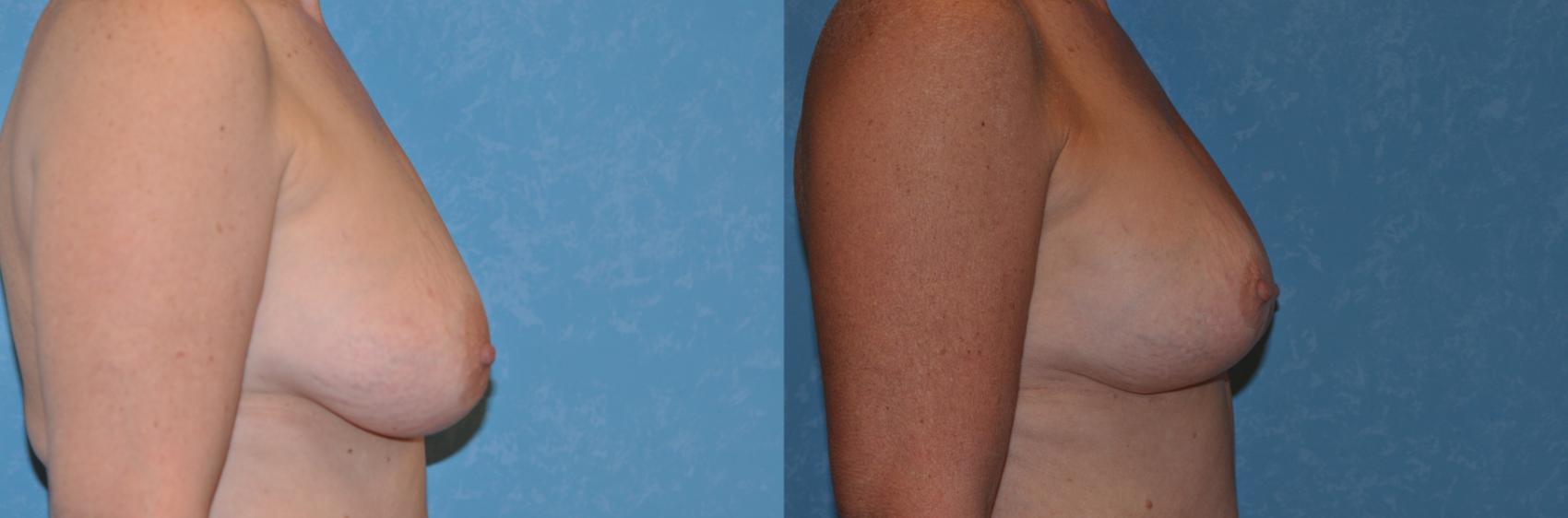 Before & After Breast Reduction Case 343 View #2 View in Toledo, Ohio