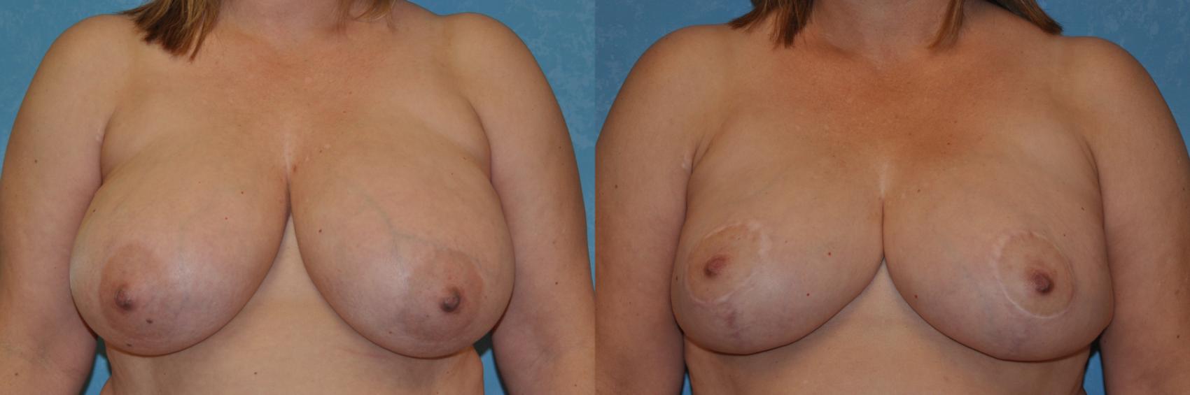 Before & After Breast Reduction Case 347 View #1 View in Toledo, Ohio