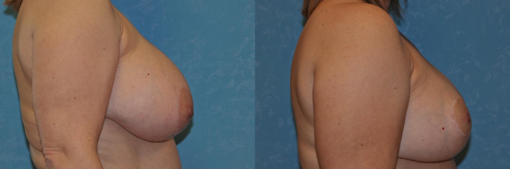 Before & After Breast Reduction Case 347 View #2 View in Toledo, Ohio