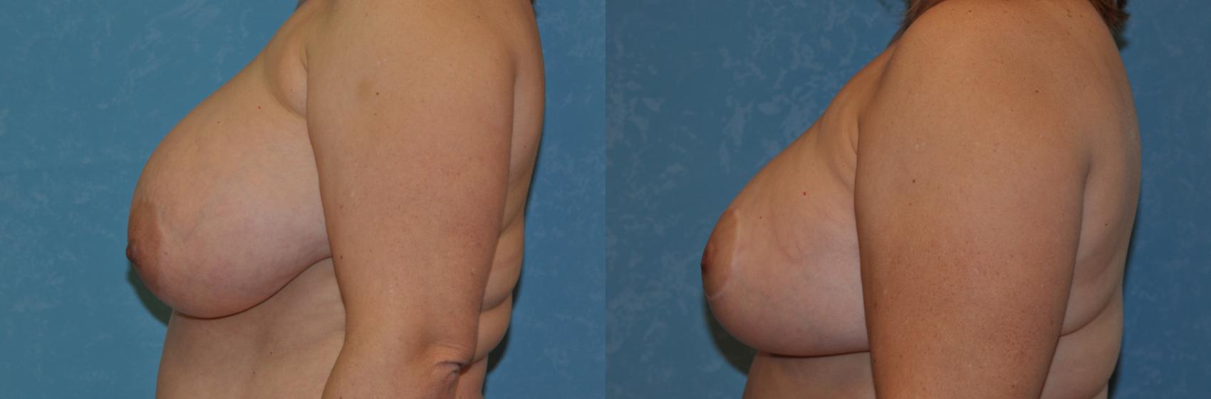 Before & After Breast Reduction Case 347 View #3 View in Toledo, Ohio