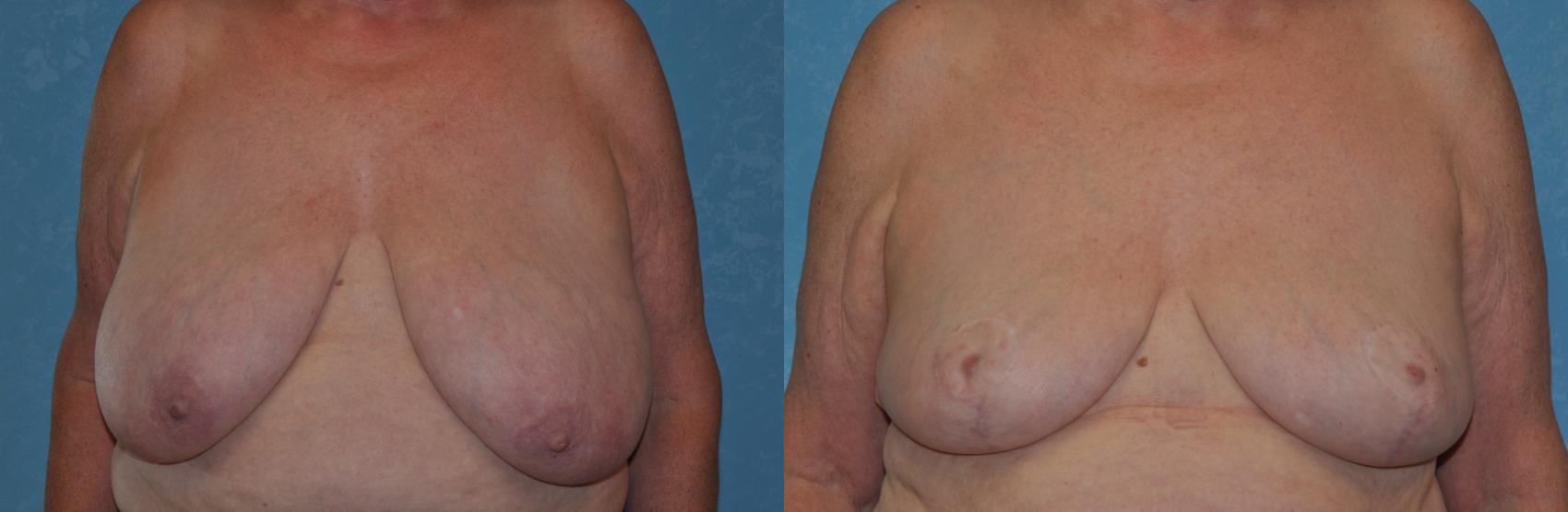Before & After Breast Reduction Case 348 View #1 View in Toledo, Ohio