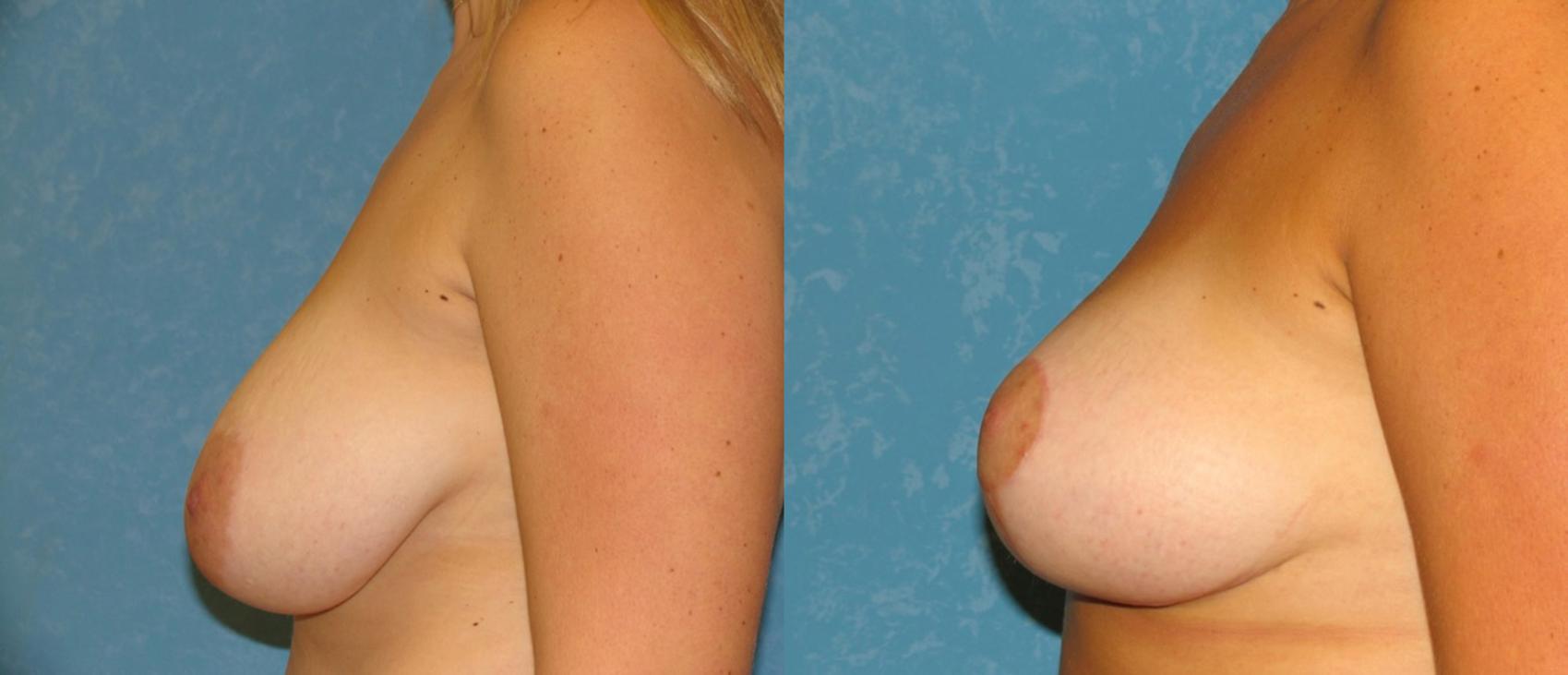 Before & After Breast Reduction Case 37 View #1 View in Toledo, Ohio