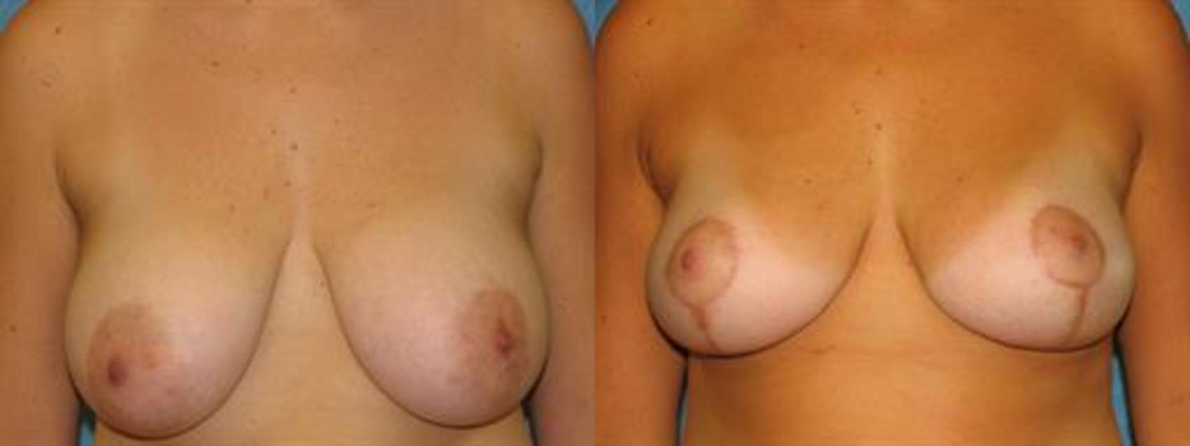 Before & After Breast Reduction Case 37 View #2 View in Toledo, Ohio
