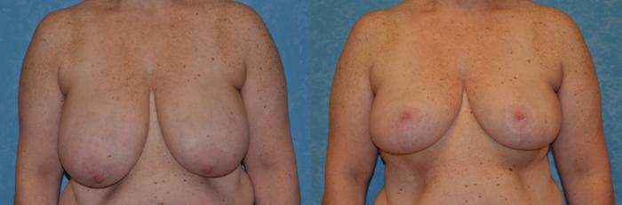 Before & After Breast Reduction Case 381 View #1 View in Toledo, Ohio