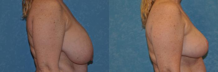 Before & After Breast Reduction Case 381 View #2 View in Toledo, Ohio