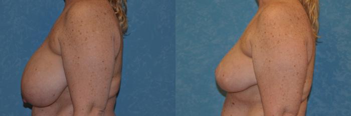 Before & After Breast Reduction Case 381 View #3 View in Toledo, Ohio