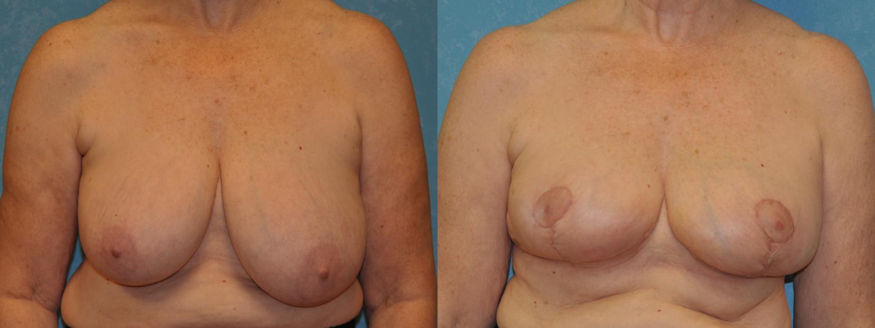 Breast Reduction