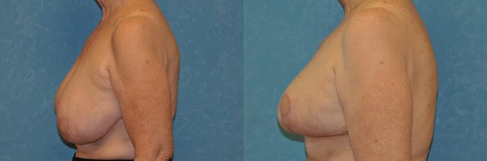 Before & After Breast Reduction Case 387 Left Side View in Toledo, Ohio