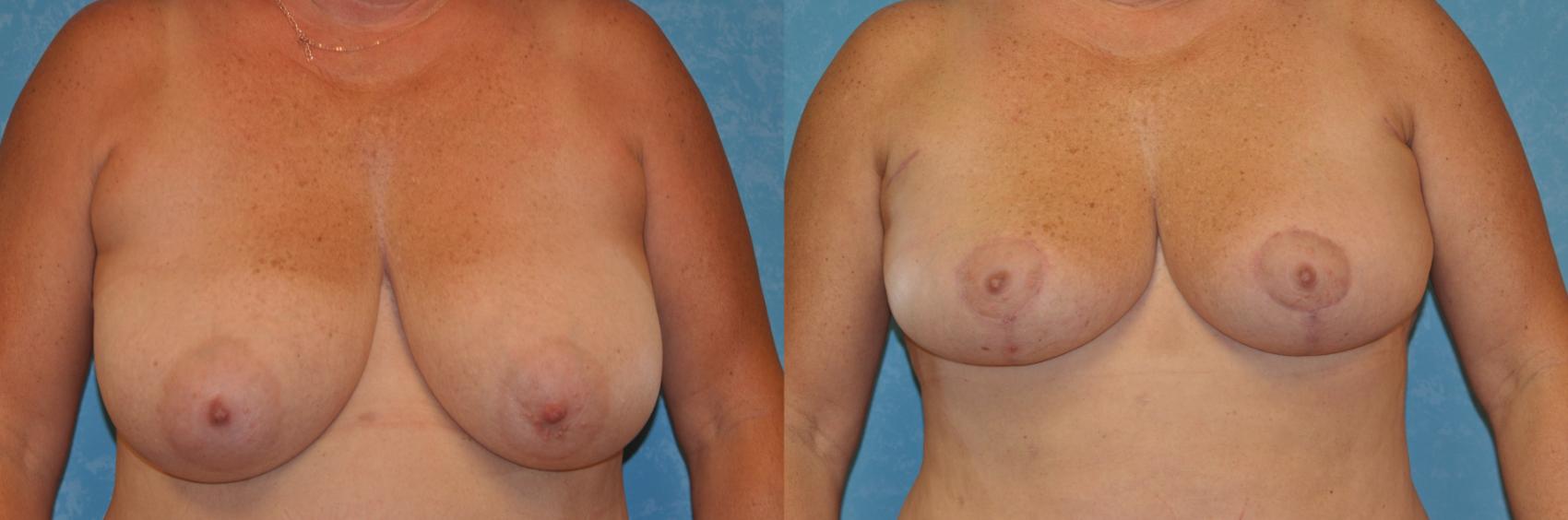 Before & After Breast Reduction Case 399 Front View in Toledo, Ohio