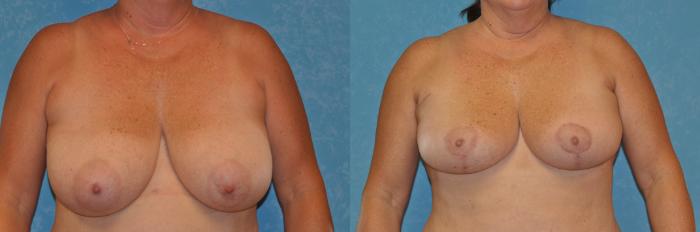 Before & After Breast Reduction Case 399 Front View in Toledo, Ohio